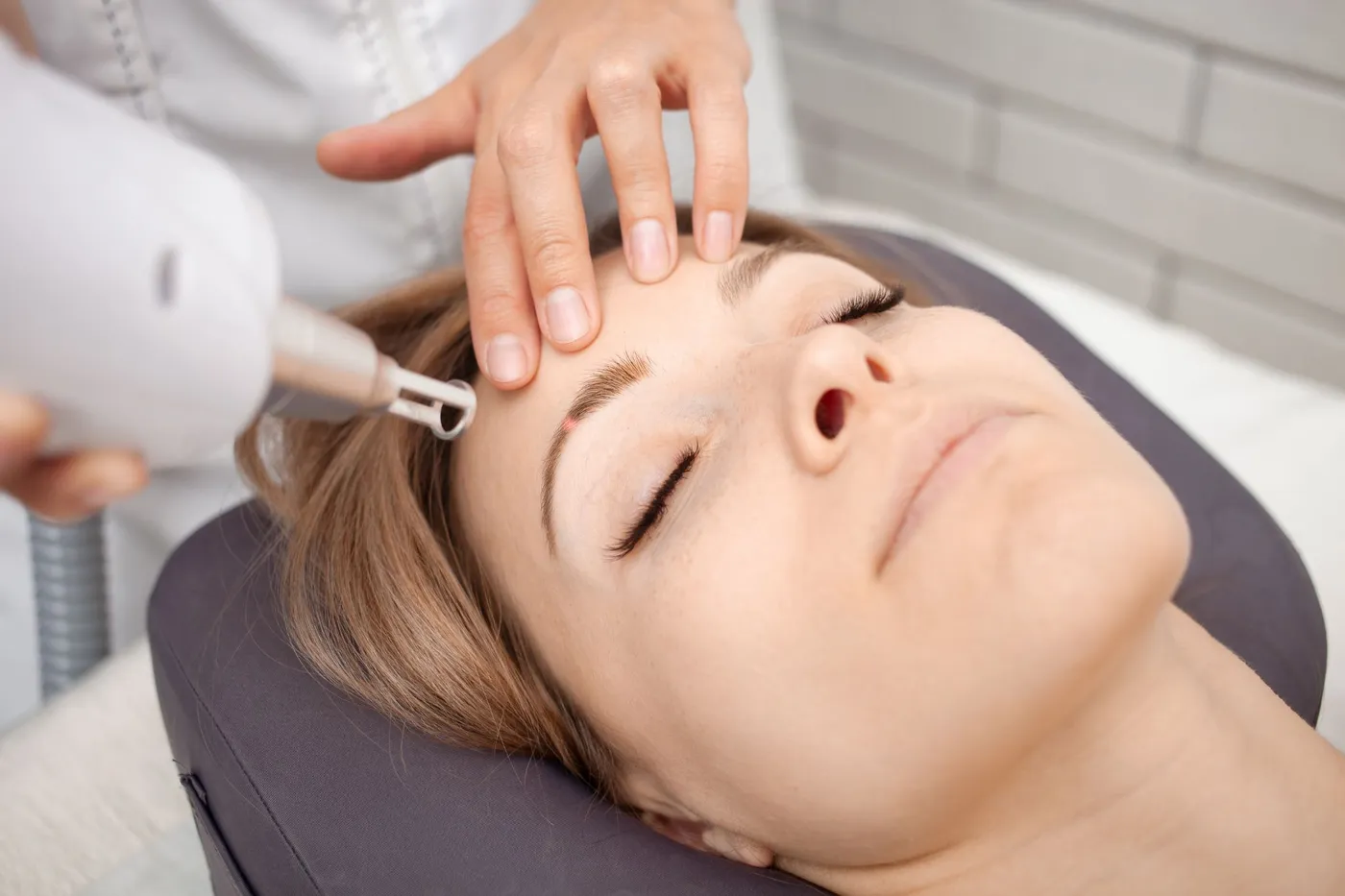 Fotona laser rosacea treatment at AURĀE Med Spa Charleston